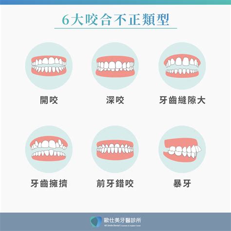 上下排牙齒平行|牙齒咬合不正遠比你想得複雜！一篇認識咬合不正的5大症狀與影響